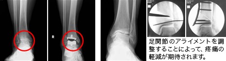 人工足関節（左）／低位脛骨骨切り術（右）