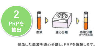 2. PRP分離：本治療専用の遠心分離機と専用キットを用いて遠心しPRPを精製抽出