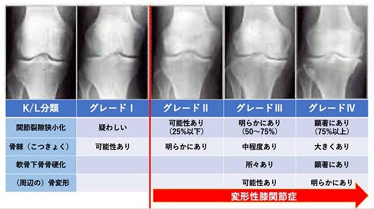PRP治療のグレードの変化